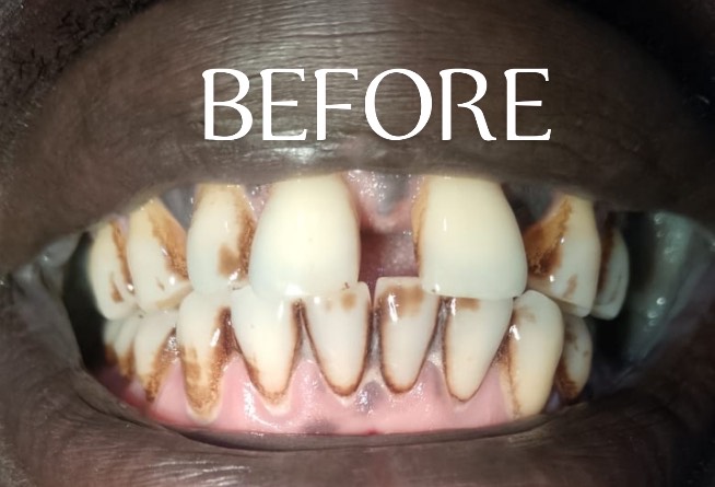 Before Treatment