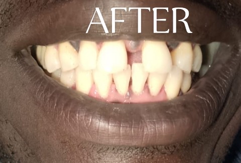 After Treatment