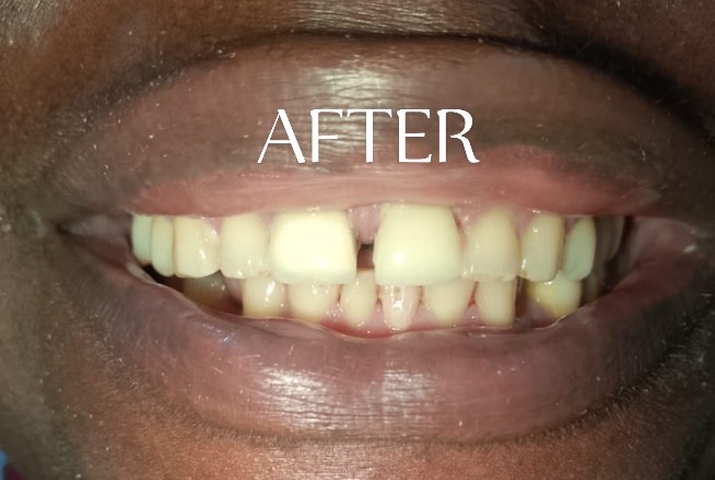 After Treatment
