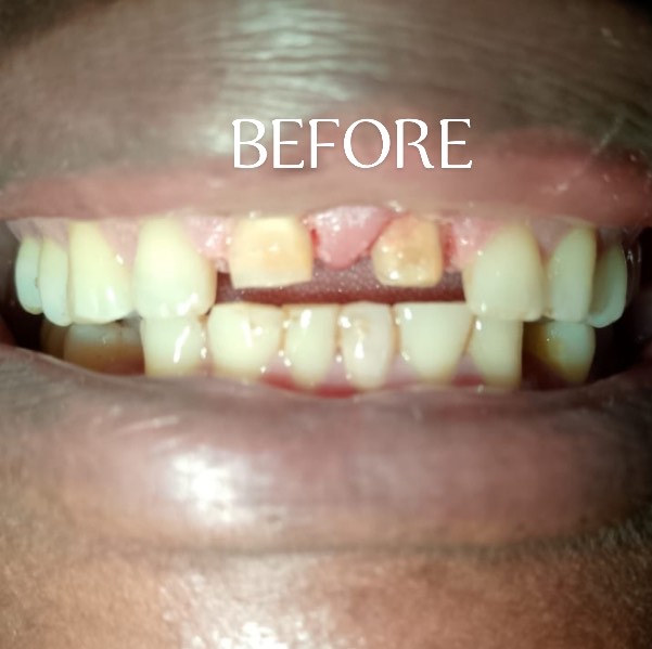 Before Treatment